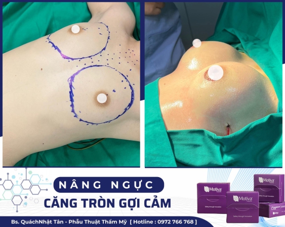 Nâng ngực nội soi